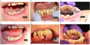 Before and Afters Of Immediate Bridge using Natural Tooth