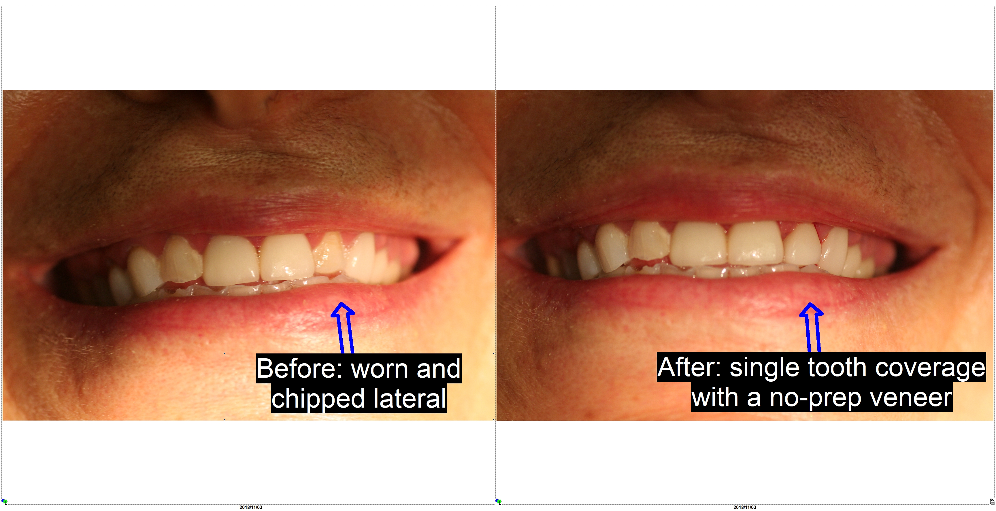 Veneer Before and After