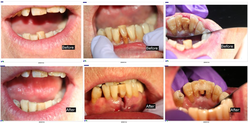 Immediate Bridge Using Natural Tooth And Ribbond McFarlane Dental