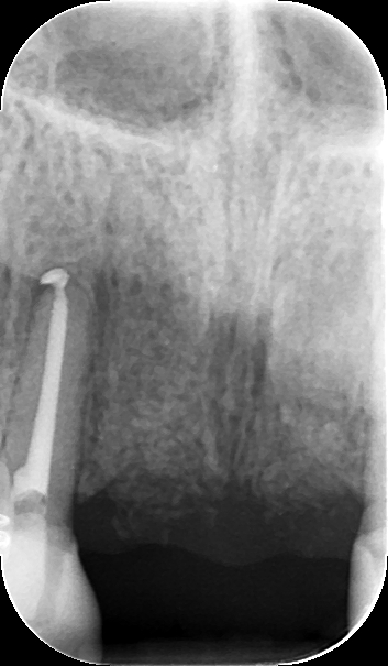 X-ray: showing the bone graft in the site replacing the missing central teeth.
