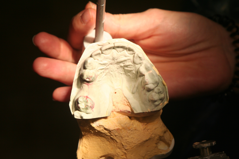 What’s Maryland Bridge? McFarlane Dental