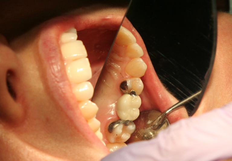 What’s Maryland Bridge? McFarlane Dental