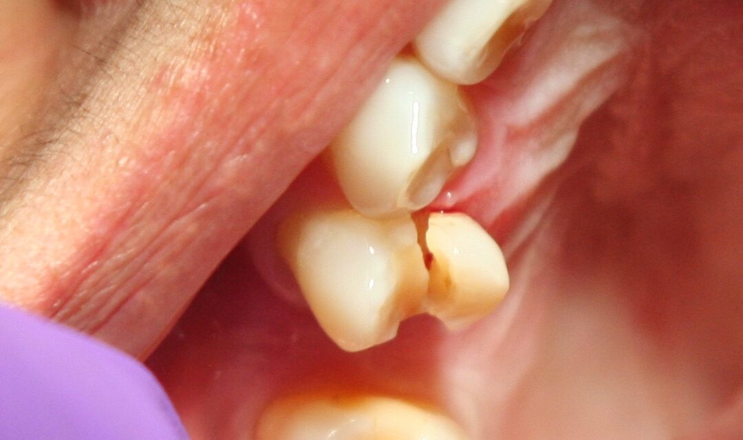 fractured tooth