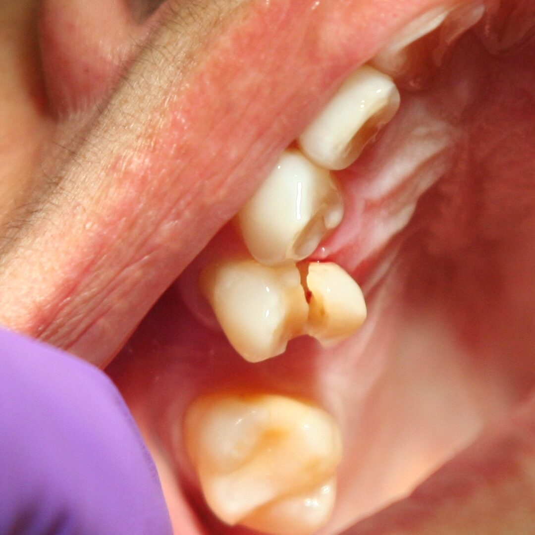 fractured tooth