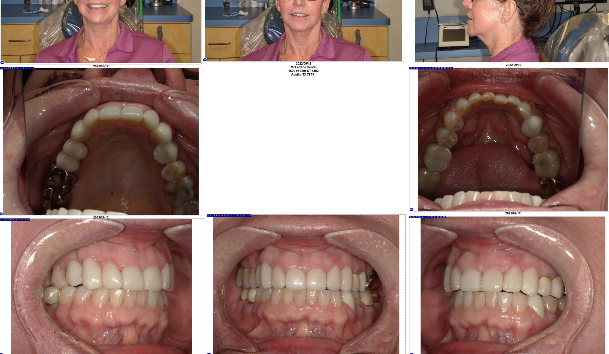 Veneers After