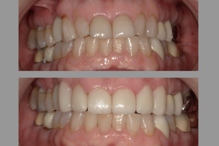 Veneers Before and After