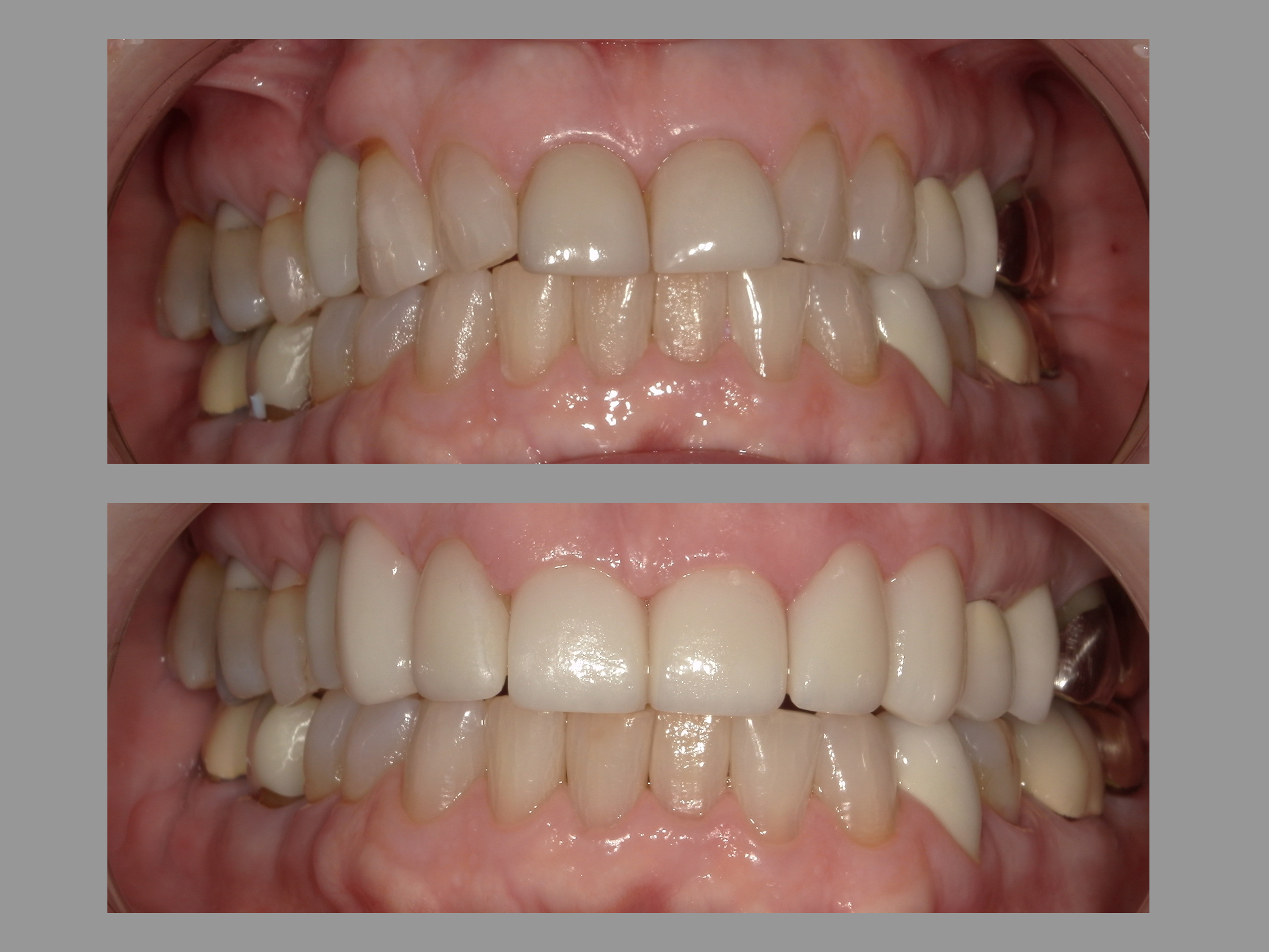 Veneers Before and After