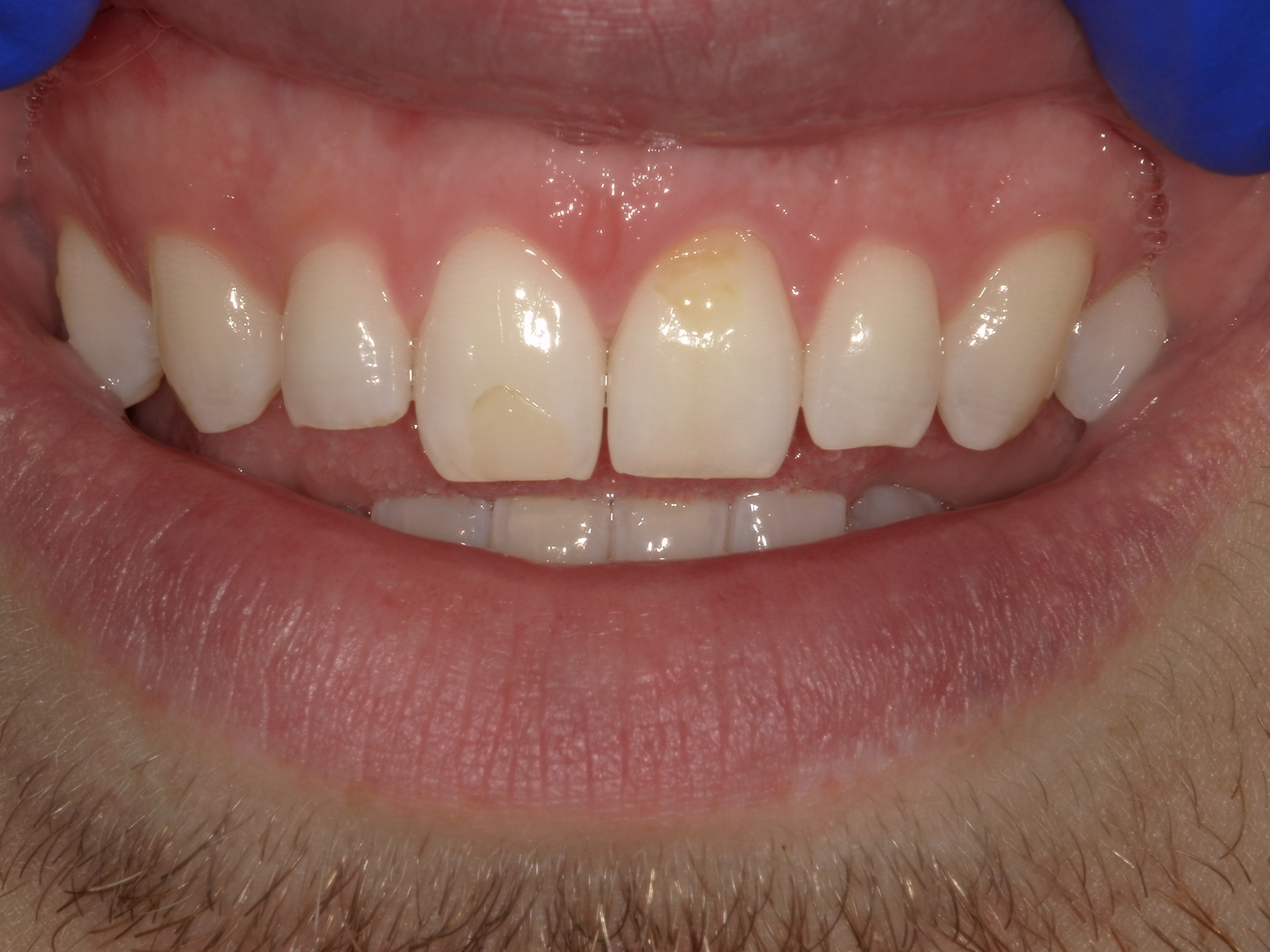 OLD Composite Pre-treatment