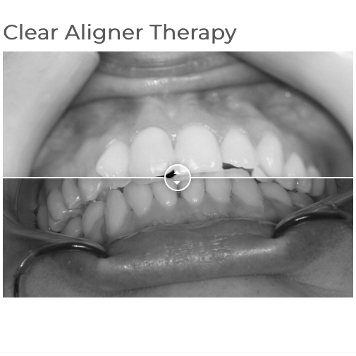 Clear Aligner Therapy