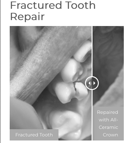 Fractured Tooth Slider Preview