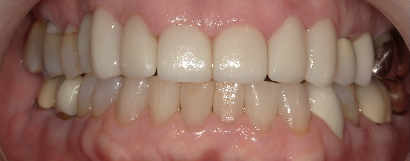 after veneers