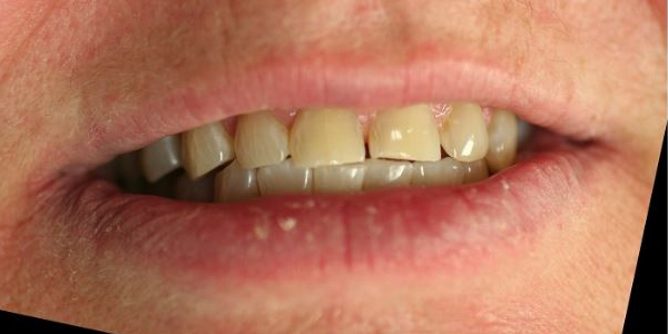 After Whitening