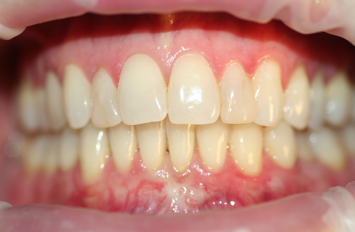 Before Veneer replacement