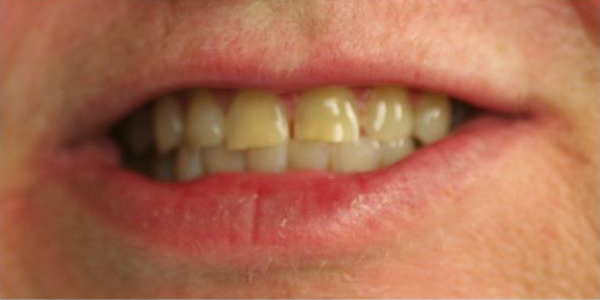 before whitening